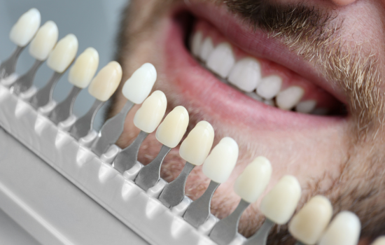 Carillas dentales. Clinica dental en Córdoba Mauramed
