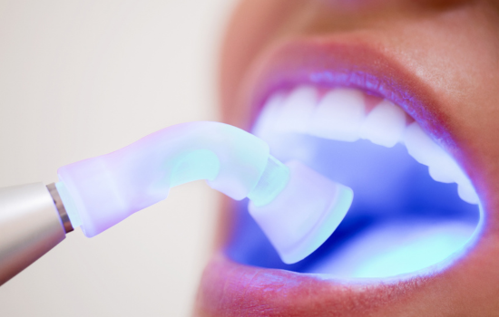 Empastes dentales Clínica dental Mauramed