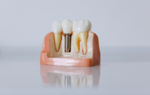 Implante unitario Clínica dental en Córdoba Mauramed