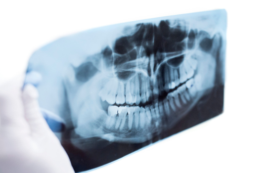 La gingivitis es la fase inicial de la enfermedad periodontal. Clínica dental Mauramed
