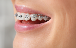 Ortodoncia en Córdoba Brackets Clínicas Mauramed