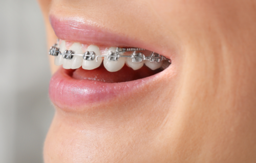 Ortodoncia en Córdoba Brackets Clínicas Mauramed