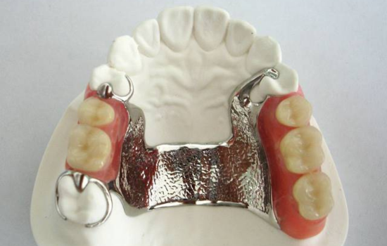 Prótesis esquelético clínica dental mauramed