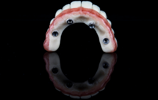 Prótesis fija-removible sobre implantes Clínica dental en Córdoba Mauramed