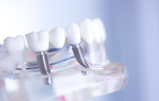 Puente sobre implante Clínica dental en Córdoba Mauramed
