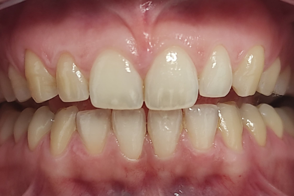Tratamiento carillas de composite Clínicas Mauramed