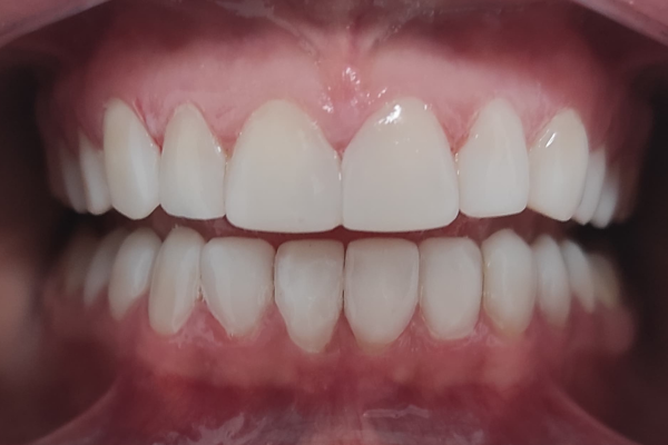 Tratamiento carillas de composite Clínicas Mauramed2