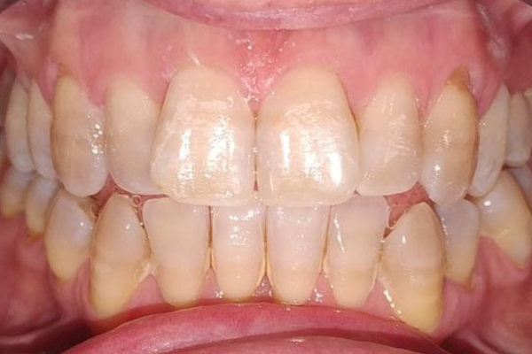 Tratamiento carillas de composite por tetraciclina Clínicas Mauramed2