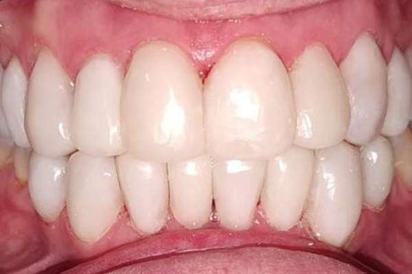 Tratamiento carillas de composite por tetraciclina Clínicas Mauramed2