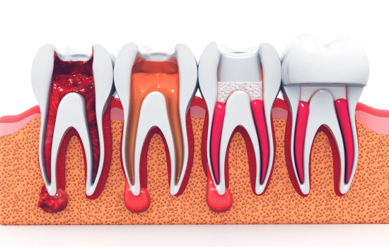endodoncia conservacion diente natural