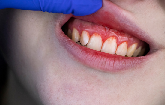 periodontitis inflamación de encias. Clínica dental Mauramed