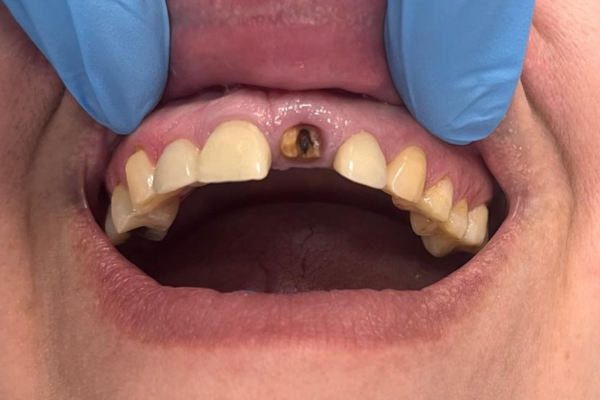 Carga inmediata antes Clinica dental mauramed