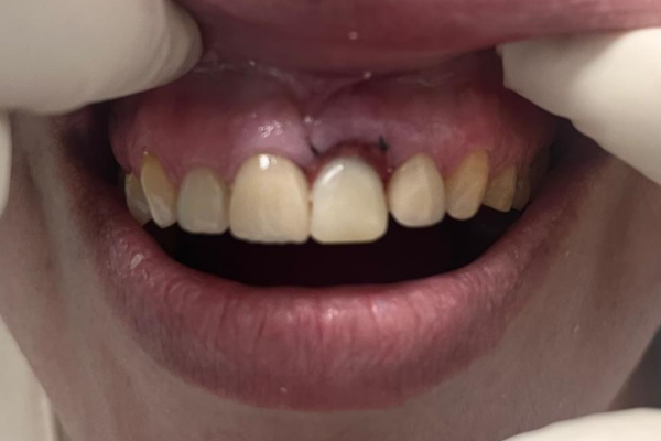 Carga inmediata después Clinica dental mauramed
