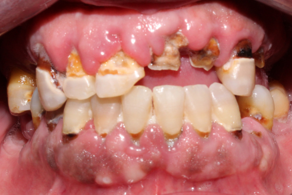 Rehabilitación completa sobre 6 implantes +12 CSI arcada superior e inferior antes. Clinica Dental Mauramed