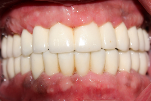 Rehabilitación completa sobre 6 implantes +12 CSI arcada superior e inferior después. Clinica Dental Mauramed