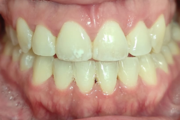 Tratamiento de blanqueamiento antes Clinica Dental Mauramed
