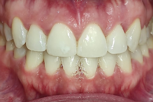 Tratamiento de blanqueamiento después Clinica Dental Mauramed
