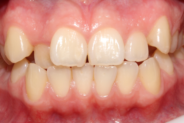 caso de apiñamiento moderado resuelto con brackets de zafiro antes. clinica dental mauramed