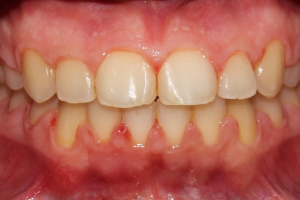 caso de apiñamiento moderado resuelto con brackets de zafiro después. clinica dental mauramed