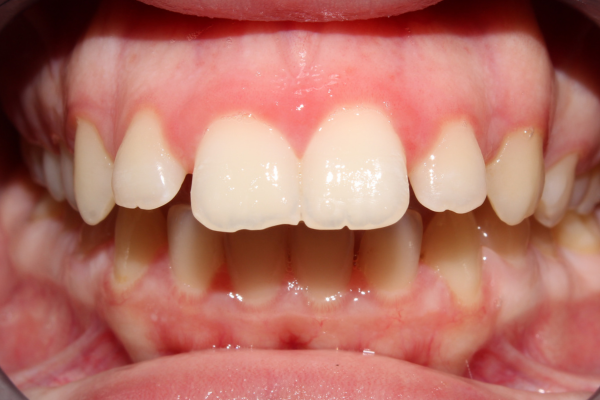 caso de clase 2 esquelética adulta antes clinica dental mauramed