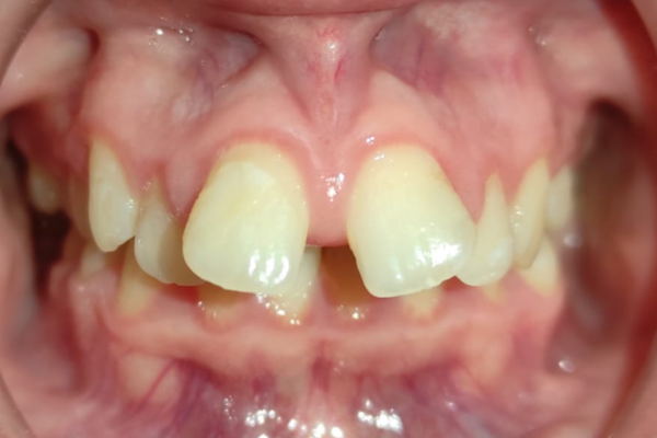 caso de desviacion mandibular clinica dental mauramed antes