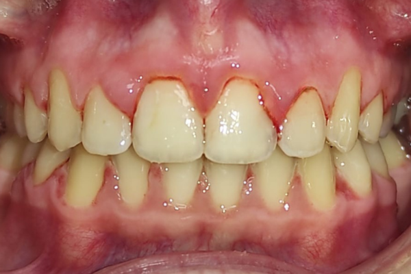 caso de desviacion mandibular clinica dental mauramed después