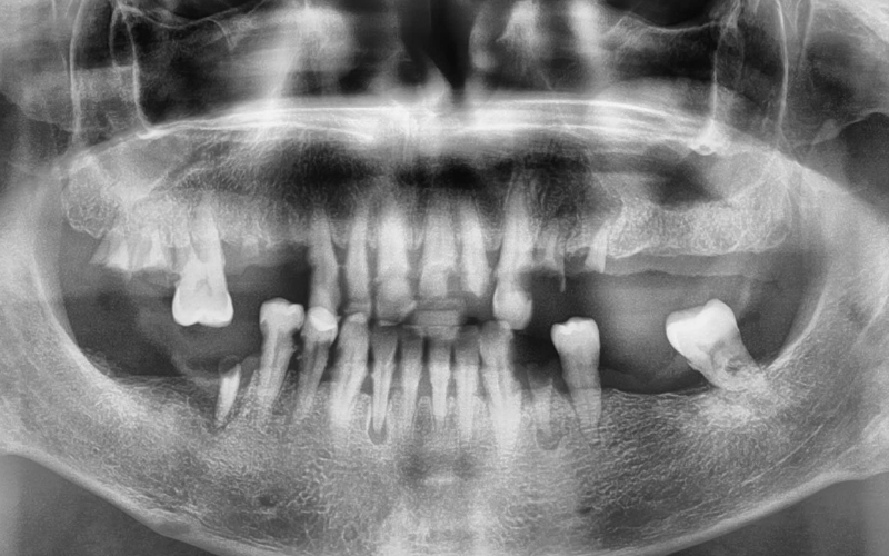 planificacion ortopantomografia previa implantes