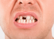 ¿Has perdido uno o más dientes y no sabes qué hacer. Clinicas Mauramed. Córdoba