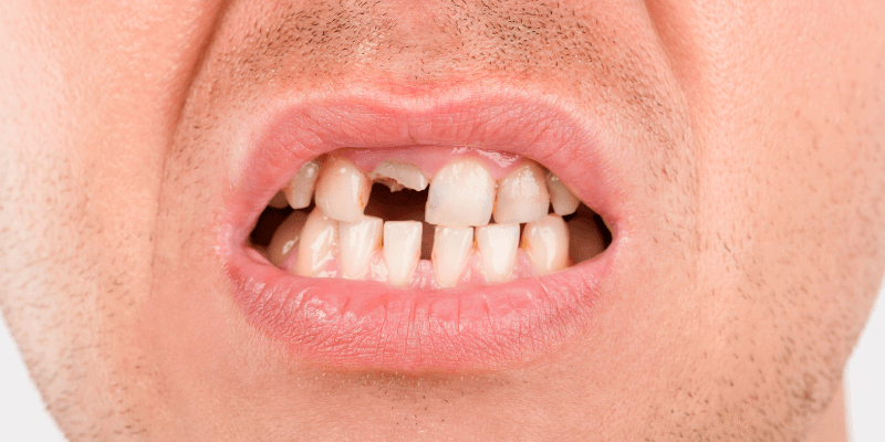 ¿Has perdido uno o más dientes y no sabes qué hacer. Clinicas Mauramed. Córdoba ¿Has perdido uno o más dientes y no sabes qué hacer. Clinicas Mauramed. Córdoba