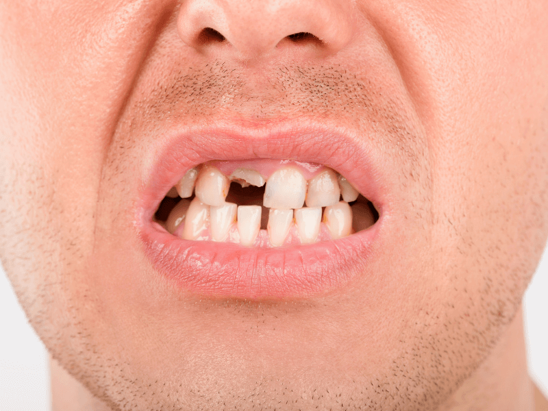 ¿Has perdido uno o más dientes y no sabes qué hacer. Clinicas Mauramed. Córdoba ¿Has perdido uno o más dientes y no sabes qué hacer. Clinicas Mauramed. Córdoba