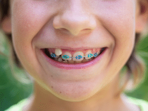 Ortodoncia infantil preventiva. Clinica dental en Córdoba clínicas mauramed.