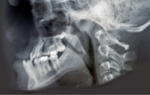 Prognatismo clinica dental cordoba mauramed