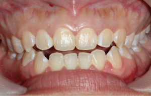 mordida abierta clinica dental cordoba mauramed