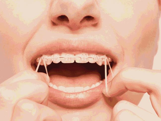gomas de ortodoncia clinica dental en cordoba mauramed gomas de ortodoncia clinica dental en cordoba mauramed