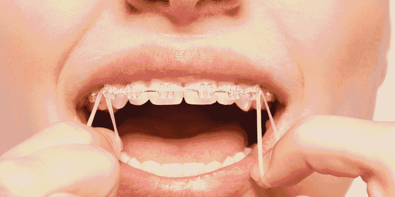 gomas de ortodoncia clinica dental en cordoba mauramed gomas de ortodoncia clinica dental en cordoba mauramed
