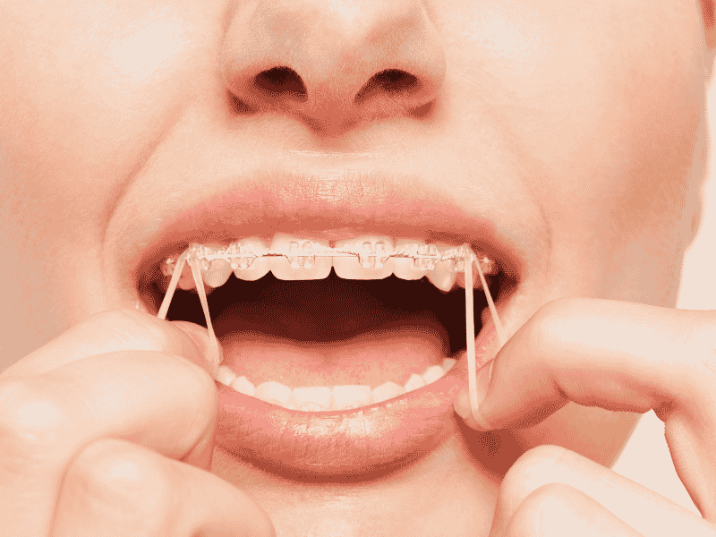 gomas de ortodoncia clinica dental en cordoba mauramed