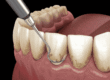 periodoncia clinica dental en cordoba mauramed