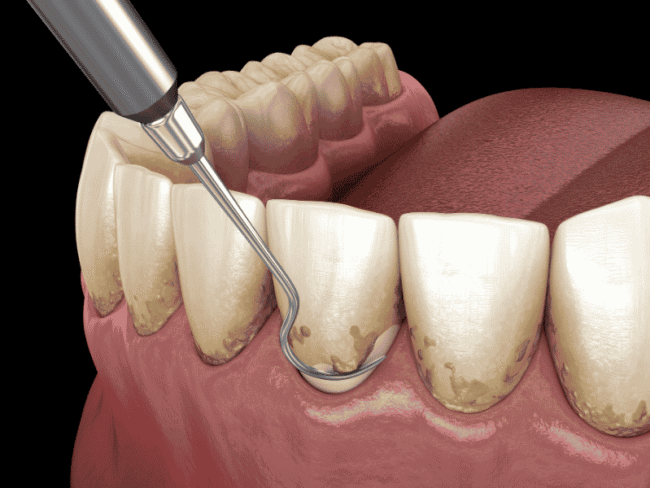 periodoncia clinica dental en cordoba mauramed periodoncia clinica dental en cordoba mauramed