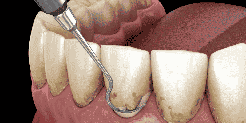 periodoncia clinica dental en cordoba mauramed periodoncia clinica dental en cordoba mauramed