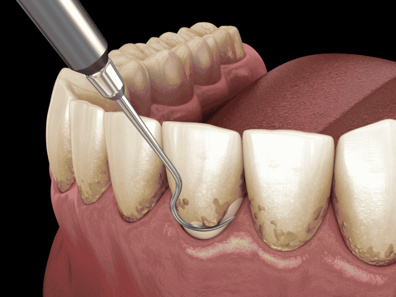 periodoncia clinica dental en cordoba mauramed