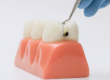 Sarro y caries. Clinica dental en cordoba mauramed