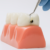Sarro y caries. Clinica dental en cordoba mauramed