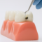 Sarro y caries. Clinica dental en cordoba mauramed