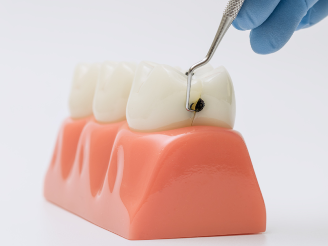 Sarro y caries. Clinica dental en cordoba mauramed Sarro y caries. Clinica dental en cordoba mauramed