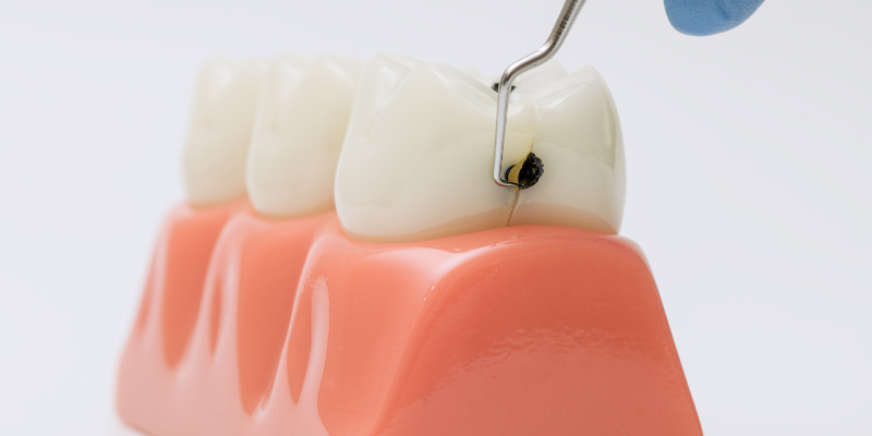Sarro y caries. Clinica dental en cordoba mauramed Sarro y caries. Clinica dental en cordoba mauramed