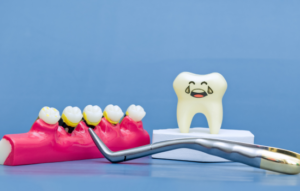 Sarro y caries. Clinica dental en cordoba mauramed2