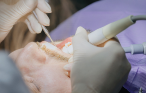 Sarro y caries. Clinica dental en cordoba mauramed3