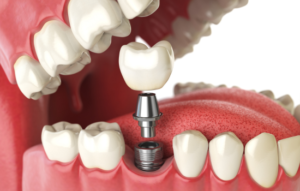 implantes dentales en cordob. resupera la funcionalidad. clinica dental en cordoba mauramed2