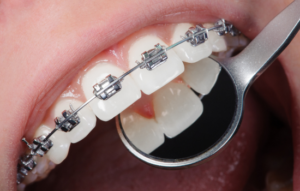 ortodoncia en cordoba. resupera la funcionalidad. clinica dental en cordoba mauramed2